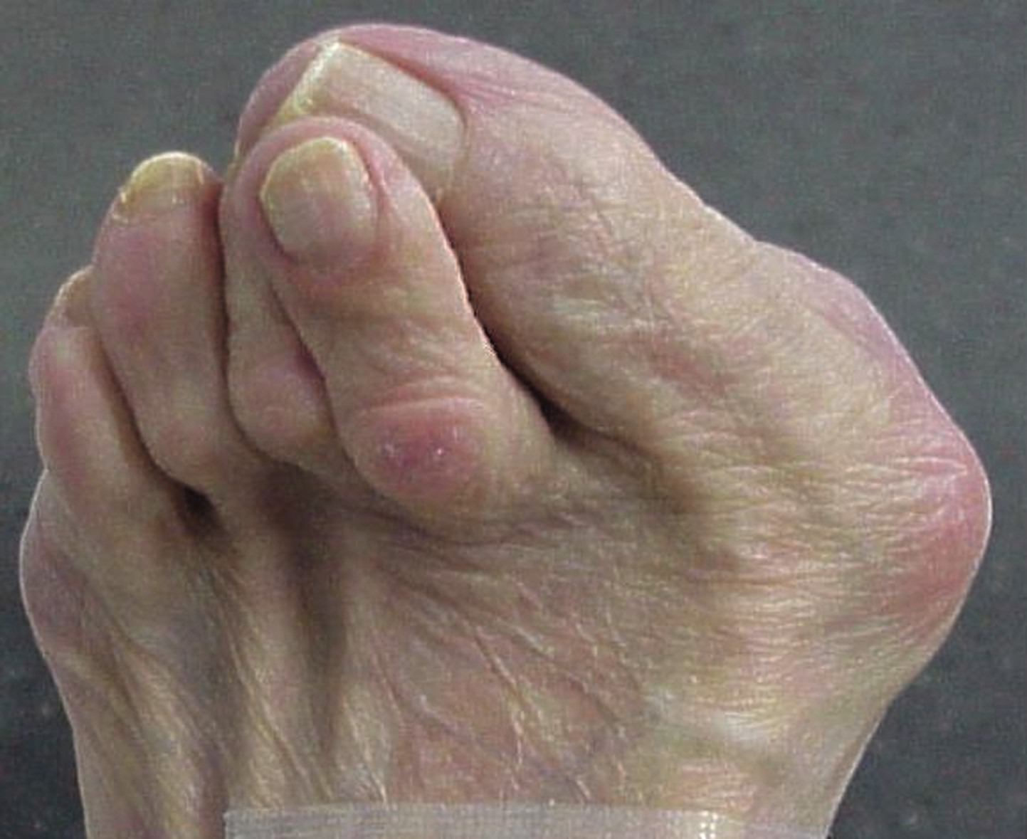 hammer toes Archives - Quality Foot Care