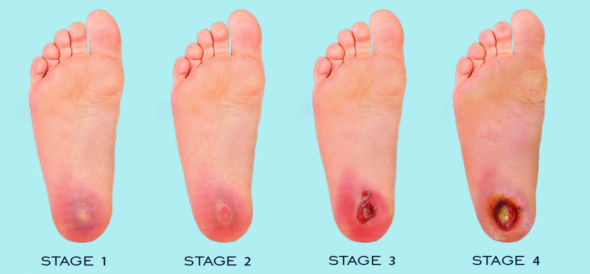 diabetic foot ulcer stages
